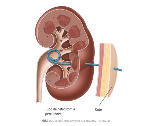 Fig. 3: Una nefrostomia percutanea all’interno del rene.