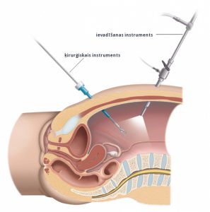 2. att. Laparoskopiskās procedūras laikā ķirurgs ievieto ķirurģiskos instrumentus caur nelieliem iegriezumiem vēderdobumā.