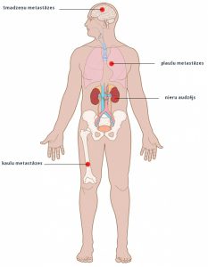5. att. Metastātisks nieru vēzis ir izplatījies plaušās, kaulos un/vai smadzenēs.