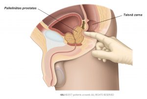 1. att. Digitāli rektālais izmeklējums prostatas lieluma, formas un konsistences noteikšanai.
