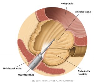 2. att. TURP procedūras gaitā ar rezektoskopu tiek izņemtas prostatas audu daļiņas.