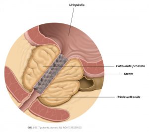 1. att. Prostatas stents uzlabo urīna plūsmu.