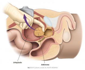 1. att. Ķirurgs noņem adenomu, izmantojot atvērtas prostatektomijas metodi.