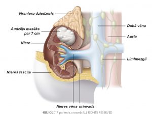 1. att. III stadija: audzējs ir izplatījies nieru vēnā, ap nieri esošajos taukaudos (nieres tauku kapsula) un/vai dobajā vēnā.