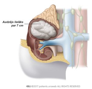 2. att. IV stadija: audzējs ir izplatījies ārpus nieres, ārpus nieres fascijas, un ir skāris virsnieru dziedzeri. Dažkārt šajā stadijā ir palielināts viens vai vairāki limfmezgli.