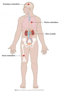 1. att. Metastātisks nieru vēzis ir izplatījies plaušās, kaulos un/vai smadzenēs.