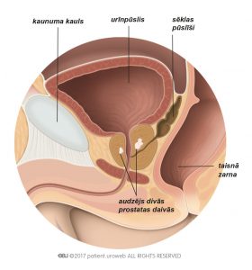 2.a attēls. T2 stadijas prostatas audzējs skar tikai prostatu.