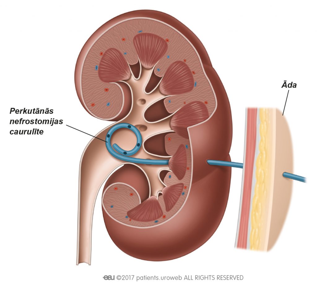 3.b att. Perkutānās nefrostomijas caurulīte nieres iekšpusē.