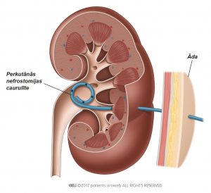 2.b att. Perkutānās nefrostomijas caurulīte nieres iekšpusē.