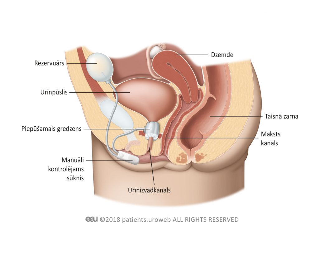 1. attēls. MUS implantācija sievietes apakšējos urīnceļos.