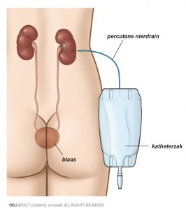 Afb. 2a: Er wordt een percutane nierdrain gebruikt om de urine rechtstreeks uit uw nier te laten afvloeien.