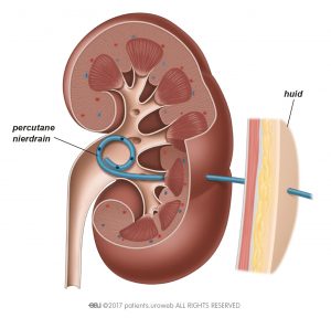 Afb. 2b: Een percutane nierdrain in de nier.