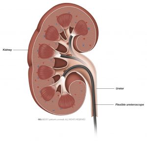 Afb. 2. Met een buigzame ureteroscoop kan uw arts praktisch elk punt in de nier bereiken.