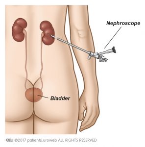 Afb. 1a. Voor het rechtstreeks verwijderen van stenen uit de nier wordt een nefroscoop gebruikt.