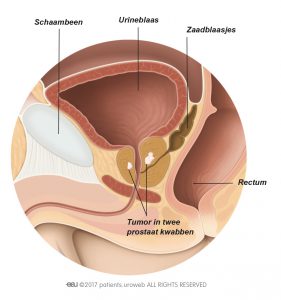 Fig. 4: Een T2-prostaattumor is beperkt tot de prostaat.