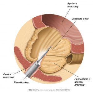 Ryc. 2. Usuwanie fragmentów tkanki prostaty przez resektoskop podczas przezcewkowa elektroresekcja gruczołu krokowego.