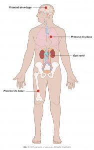 Ryc. 5. Rozsiany rak nerki z przerzutami do płuca, kości i mózgu.