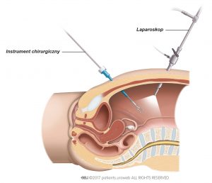 Ryc. 2. Przy zabiegu laparoskopowym chirurg wprowadza narzędzia przez niewielkie nacięcia w ścianie brzucha.