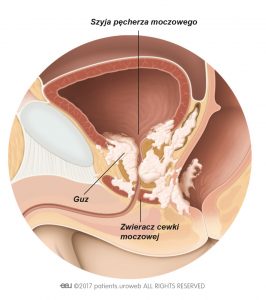 Stadium T4 oznacza, że rak nacieka szyję pęcherza, zwieracze układu moczowego, odbytnicę lub ścianę miednicy mniejszej.
