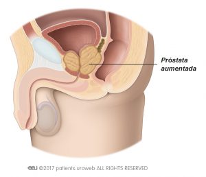 Fig. 2: Uma próstata aumentada comprimindo a uretra e a bexiga.