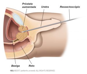 Fig. 1: Cirurgia através da uretra.