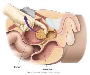 Fig. 1: O cirurgião remove o adenoma durante a prostatectomia aberta.