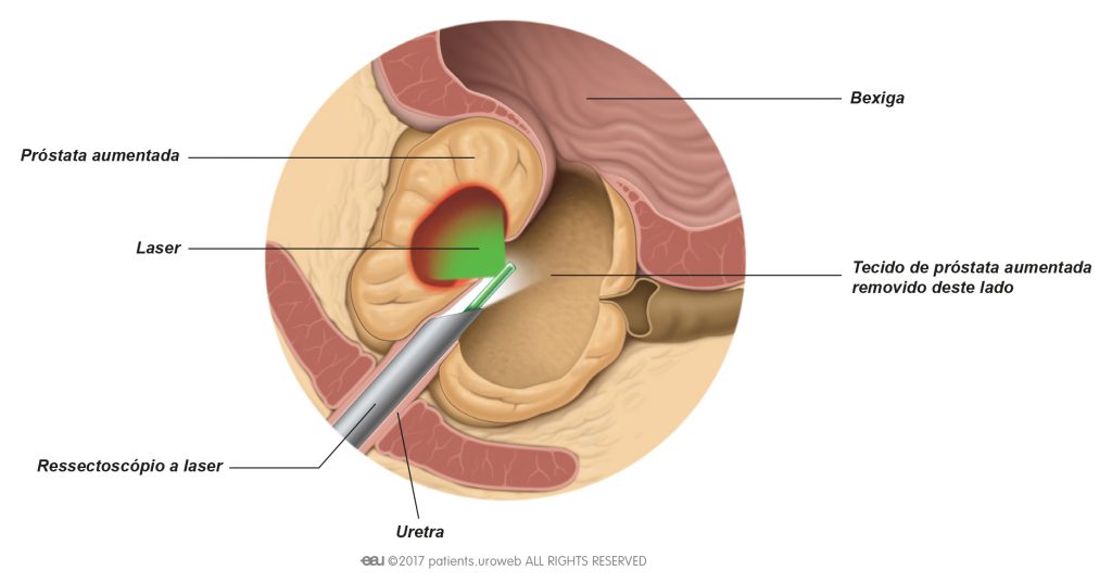 Tratamentul laser pentru prostata - Terapia Greenlight pentru HBP