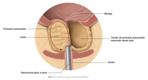 Fig. 2: O laser corta partes da próstata durante a enucleação com laser.