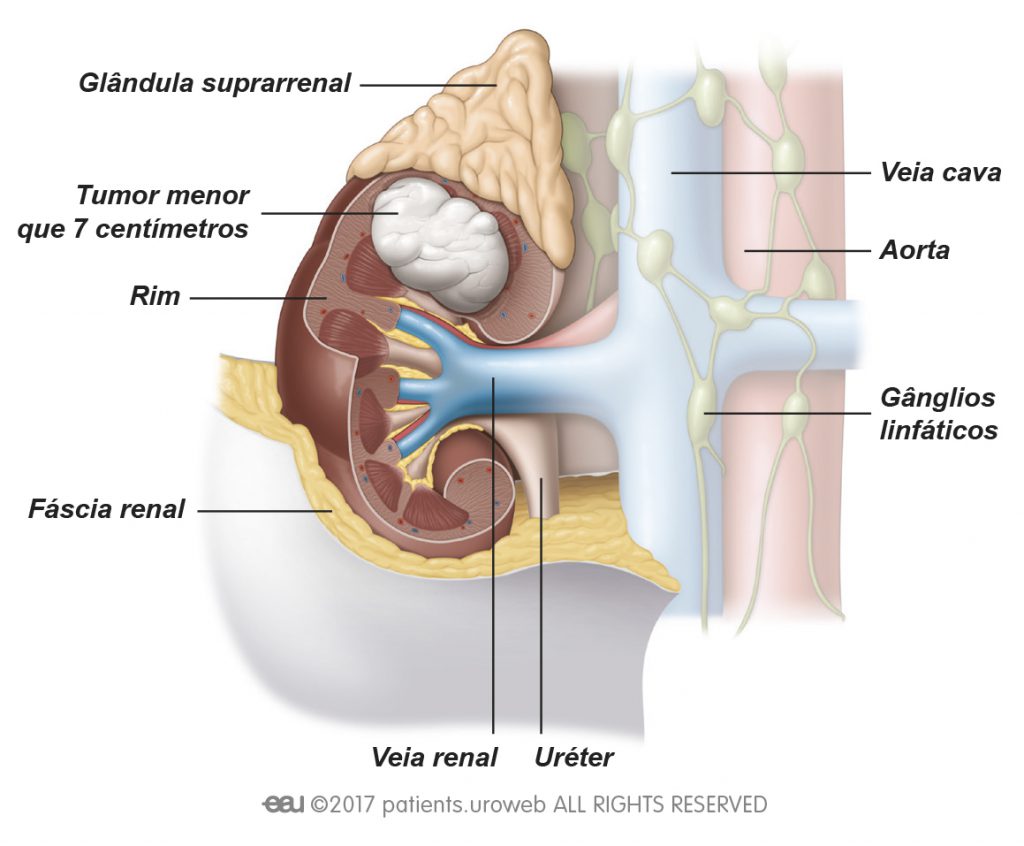 Fig. 1: Um tumor renal de estádio I: é um tumor até aos 7 cm, limitado ao rim.