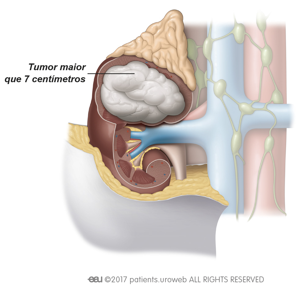 Fig. 2: Os tumores de estádio II ainda estão limitados ao rim, mas são maiores que 7 cm.