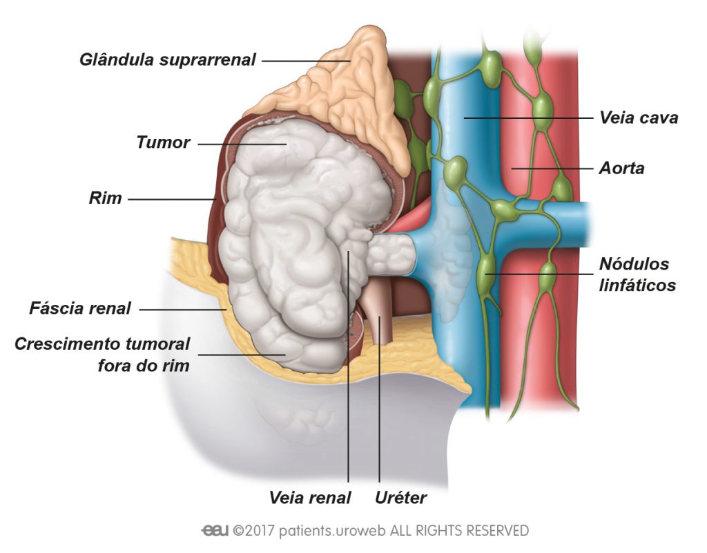Fig. 3: Os tumores de estádio espalharam-se para a veia renal, para o tecido adiposo junto ao rim (gordura perirrenal) ou para a veia cava.