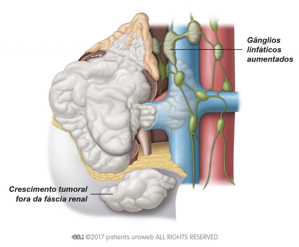 Fig. 4: Os tumores de estádio IV espalharam-se para fora do rim, para além da fáscia renal e para a glândula suprarrenal. Por vezes, um ou mais gânglios linfáticos estão aumentados neste estádio.