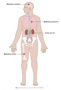 Fig. 1: Metástases O cancro do rim metastático que pode espalhar-se para os pulmões, ossos ou cérebro.