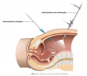 Fig. 2: Para a cirurgia laparoscópica o cirurgião insere os instrumentos cirúrgicos através de pequenas incisões no abdómen.
