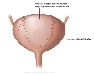 Fig. 4: Cirurgia vesical para aumentar o tamanho da bexiga.