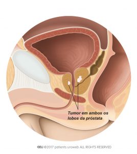 Fig. 2 Um tumor prostático T2 é limitado à próstata.