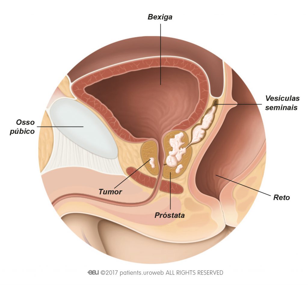 rate pentru prostatită zona periferica a rinichilor