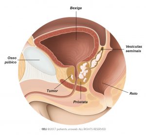 Fig. 1: Tumor T3 da próstata que se espalhou para as vesículas seminais.