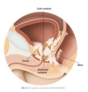 Fig. 2: Tumor T4 da próstata que se espalhou para o colo vesical, esfíncter urinário e reto.