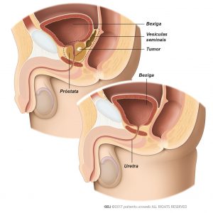 Fig. 1: Durante a prostatectomia radical, o cirurgião retira a totalidade da próstata e as vesículas seminais.