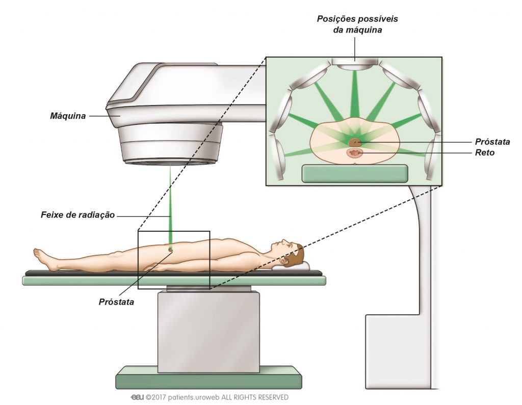 radioterapia prostatica originile prostatitei cronice guskov a p
