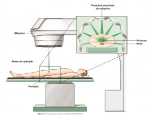Fig. 1: Radioterapia externa para danificar e matar as células do cancro.