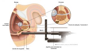 Fig. 2: Na braquiterapia, a fonte de radiação é inserida diretamente na próstata.