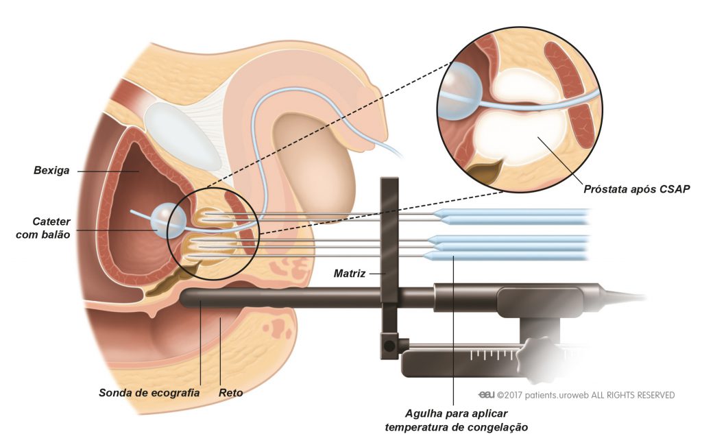 Fig. 1: A crio-ablação da próstata (CAP) mata as células do cancro ao congelá-las.