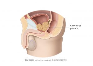 Fig. 2: Próstata de volume aumentado a comprimir a uretra e a bexiga.