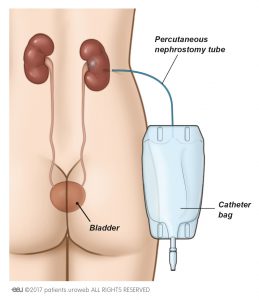 Fig. 2a: Um tubo de nefrostomia percutânea é utilizado para drenar diretamente urina do rim para um saco coletor.