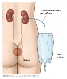 Fig. 3a: Um tubo de nefrostomia percutânea é utilizado para drenar diretamente urina do rim para um saco coletor.