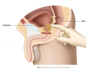 Fig. 1: Toque retal para avaliar o tamanho, forma e consistência da próstata.
