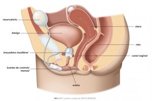 Fig. 1: Colocação de EUA no aparelho urinário inferior da mulher.