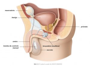 Fig. 1: Esfíncter urinário artificial no trato urinário inferior do homem.